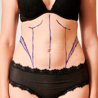 “La abdominoplastia es un método para moldear el cuerpo y no para bajar de peso”