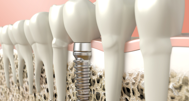 Implantes dentales: recomendaciones y cuidados para que todo vaya bien