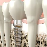 Implantes dentales: recomendaciones y cuidados para que todo vaya bien