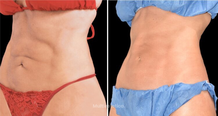 ¿Ya conoces C-WAVE? ideal vs las zonas adiposas