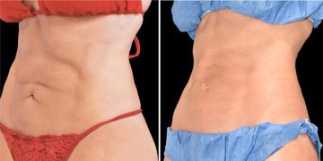 ¿Ya conoces C-WAVE? ideal vs las zonas adiposas ¿Ya conoces C-WAVE? ideal vs las zonas adiposas