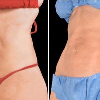 ¿Ya conoces C-WAVE? ideal vs las zonas adiposas