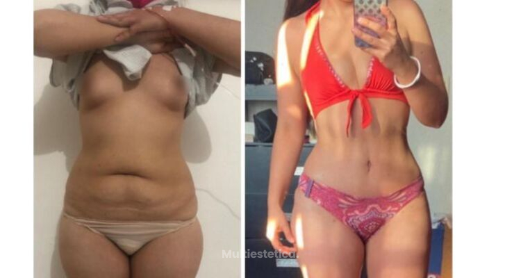"La liposucción asistida por ultrasonido mejora los resultados"
