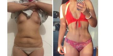"La liposucción asistida por ultrasonido mejora los resultados" "La liposucción asistida por ultrasonido mejora los resultados"