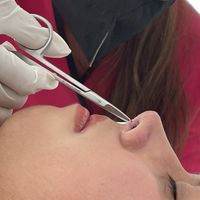 Beneficios del vendaje posrinoplastia