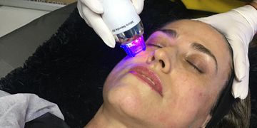 Radiofrecuencia fraccionada con agujas: rejuvenecimiento facial sin cirugia