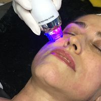 Radiofrecuencia fraccionada con agujas: rejuvenecimiento facial sin cirugia