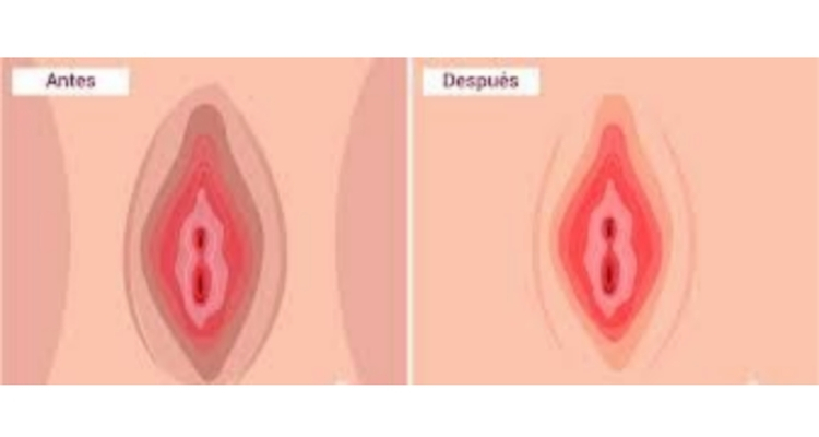Blanqueamiento genital con láser y su efectividad