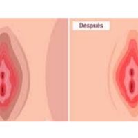 Blanqueamiento genital con láser y su efectividad