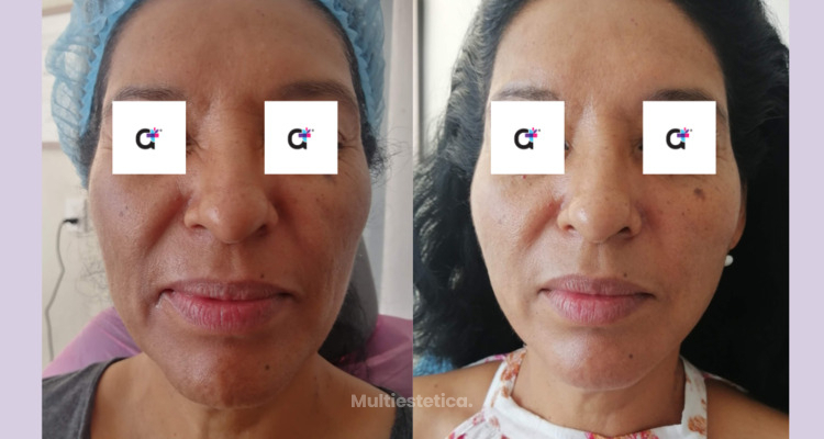 ¿Cómo hacer "duradero" el resultado de mi tratamiento de rejuvenecimiento facial?