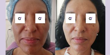 ¿Cómo hacer "duradero" el resultado de mi tratamiento de rejuvenecimiento facial?