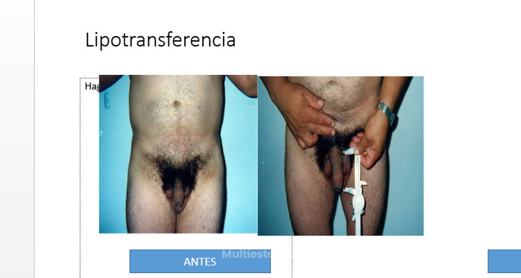 ¿Quieres aumentar el tamaño de tu pene de manera natural? Descubre la lipotransferencia de pene
