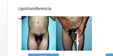 ¿Quieres aumentar el tamaño de tu pene de manera natural? Descubre la lipotransferencia de pene