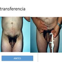 ¿Quieres aumentar el tamaño de tu pene de manera natural? Descubre la lipotransferencia de pene