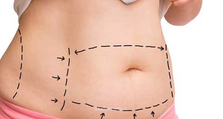 Hidrolipoclasia: ¿La solución definitiva para eliminar grasa localizada?