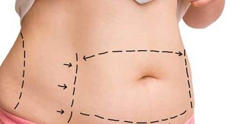 Hidrolipoclasia: ¿La solución definitiva para eliminar grasa localizada? Hidrolipoclasia: ¿La solución definitiva para eliminar grasa localizada?