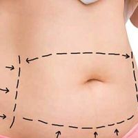 Hidrolipoclasia: ¿La solución definitiva para eliminar grasa localizada?