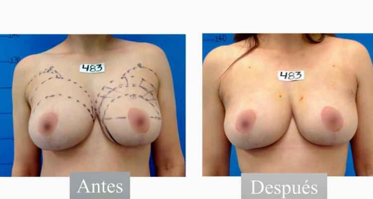 ¡Recupera la confianza en tu cuerpo con una mastopexia y lipoaspiración!