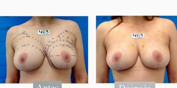 ¡Recupera la confianza en tu cuerpo con una mastopexia y lipoaspiración!