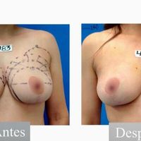 ¡Recupera la confianza en tu cuerpo con una mastopexia y lipoaspiración!