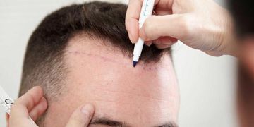 ¿Estás lidiando con la pérdida de cabello? Pros y contras del trasplante capilar con técnica FUE.