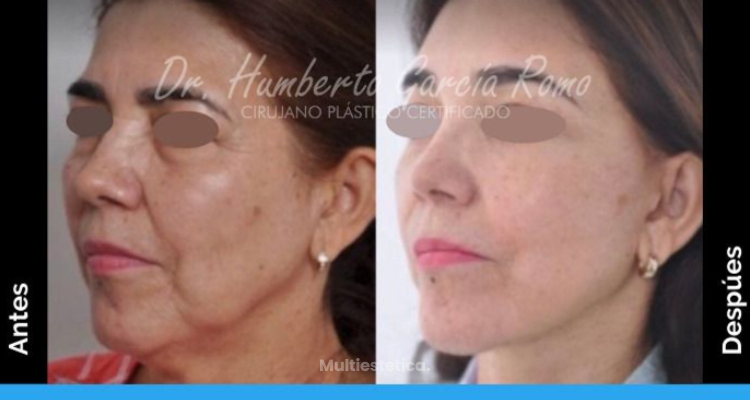 "El lifting facial aumenta considerablemente la autoestima y les cambia la vida a las pacientes"