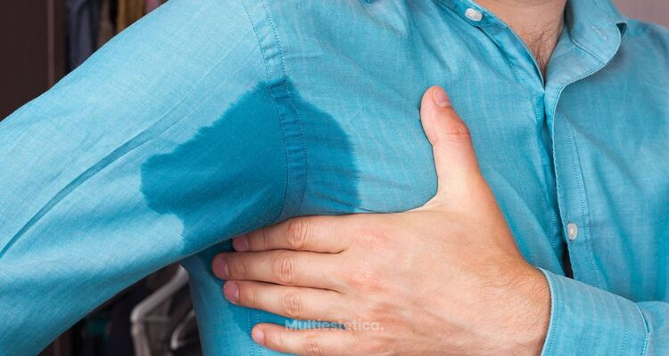 Sudor excesivo y la solución definitiva: la cirugía para hiperhidrosis axilar.