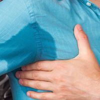 Sudor excesivo y la solución definitiva: la cirugía para hiperhidrosis axilar.
