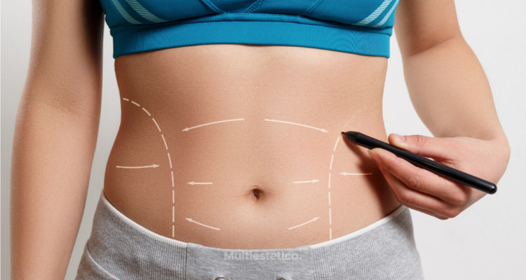 ¡Bye bye abdomen flácido! Descubre la maravilla de la abdominoplastia
