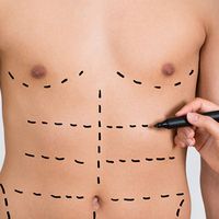¡Deslumbra con tu figura! Descubre la lipoescultura de alta definición