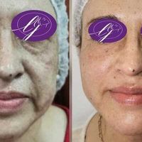 Hilos tensores y ácido hialurónico: combinación comprobada de rejuvenecimiento facial