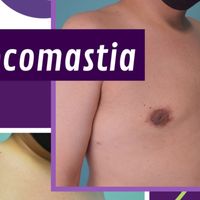 Ginecomastia y la masculinización del tórax