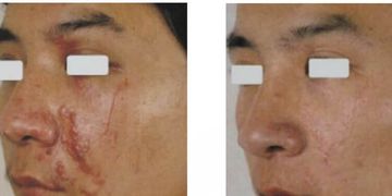 Cicatrices de acné: por qué el láser C02 funciona en unas y en otras no Cicatrices de acné: por qué el láser C02 funciona en unas y en otras no
