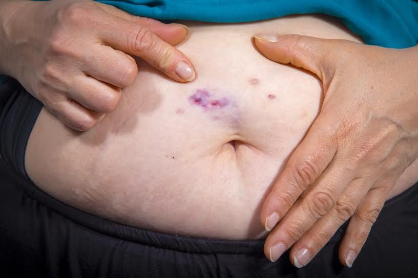 Mesoterapia para adelgazar efectos secundarios
