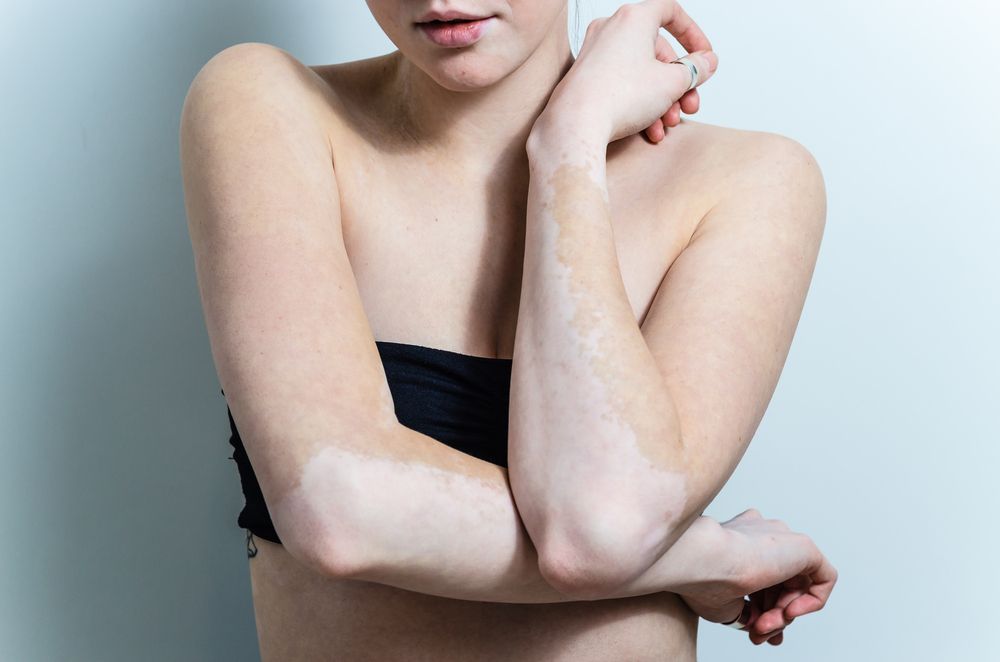 vitiligo-2.jpg