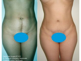 Lipoabdominoplastia + Lipoinyección Glútea