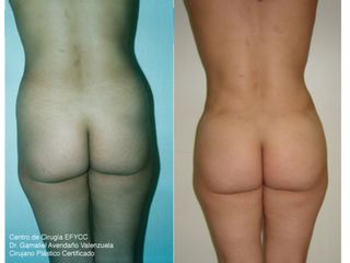 Lipoabdominoplastia + Lipoinyección Glútea