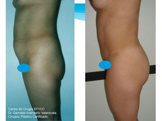 Lipoabdominoplastia + Lipoinyección Glútea