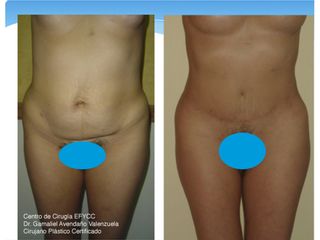 Lipoabdominoplastia + Lipoinyección Glútea