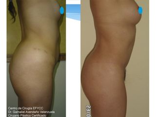 Lipoabdominoplastia + Lipoinyección Glútea
