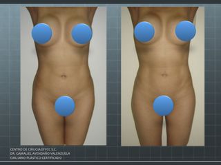 Lipoescultura Corporal
