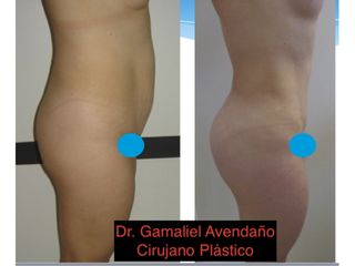 Lipoescultura Corporal + Lipoinyección glútea
