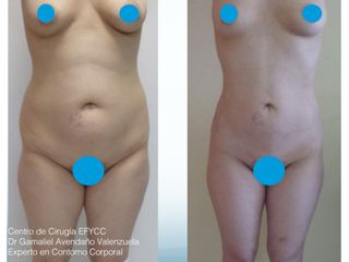 Lipo+Lipoiny