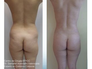 Lipo+Lipoiny