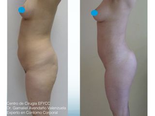 Lipo+Lipoiny