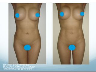 Lipo+Lipoiny