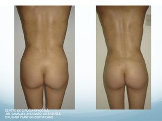 Lipo+Lipoiny