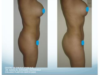 Lipo+Lipoiny