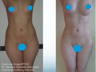 Lipo+Lipoiny+Aum