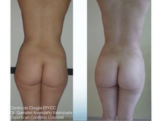 Lipo+Lipoiny+Aum